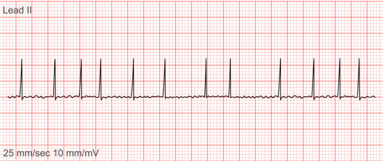 ECG rhythm strip showing Atrial Fibrillation with irregularly irregular rhythm and absent P waves, part of critical ECG rhythms nurses must recognize.