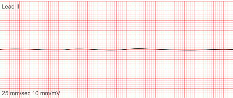 ECG rhythm strip showing Cardiac Asystole as a flatline with no electrical activity—one of the most critical ECG rhythms requiring immediate CPR.