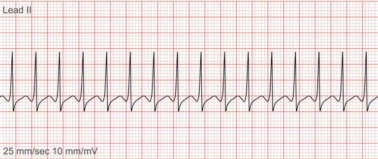 ECG rhythm strip showing Supraventricular Tachycardia with narrow, rapid, and regular QRS complexes—an important ECG rhythm in emergency cardiac care.