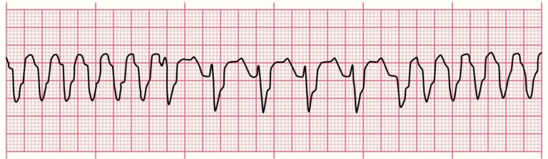 ECG rhythm strip showing Polymorphic Ventricular Tachycardia with wide, irregular QRS complexes varying in shape and amplitude—one of the most critical ECG rhythms.