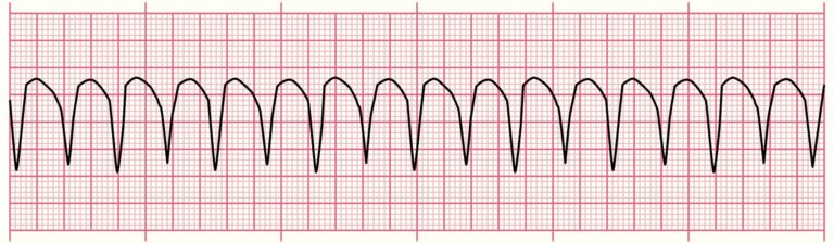 ECG rhythm strip showing Monomorphic Ventricular Tachycardia with wide, regular QRS complexes, a critical ECG rhythm requiring emergency response.