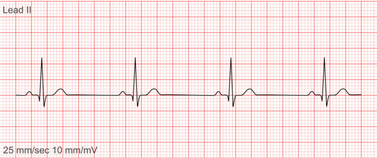 Rekaman irama EKG menunjukkan Sinus Bradikardia dengan kompleks P-QRS-T reguler dan denyut jantung di bawah 60 bpm, termasuk dalam irama EKG penting.