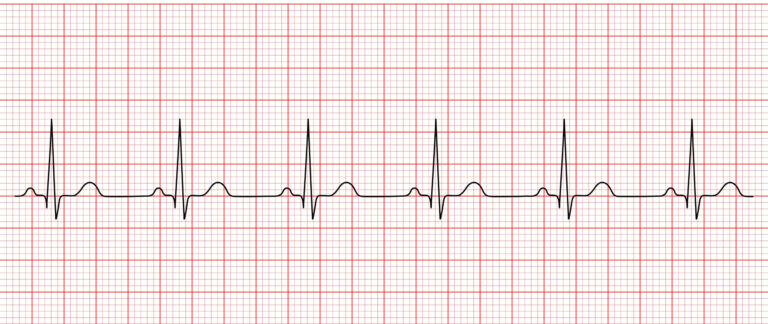 Rekaman EKG menunjukkan Irama Sinus Normal dengan kompleks P-QRS-T yang reguler, termasuk dalam ritme EKG penting yang harus dikenali perawat.