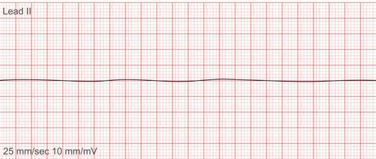 Rekaman menunjukkan Asistol Jantung berupa garis datar tanpa aktivitas listrik, salah satu kondisi paling kritis yang memerlukan RJP segera.