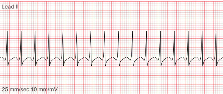 Rekaman menunjukkan Takikardia Supraventrikular dengan kompleks QRS yang sempit, cepat, dan reguler, termasuk kondisi penting dalam penanganan gawat darurat.