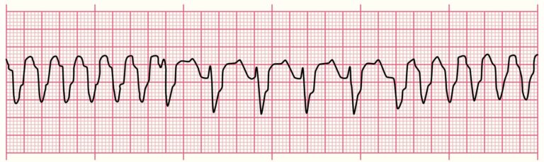 Rekaman irama EKG menunjukkan Ventrikel Takikardia Polimorfik dengan kompleks QRS lebar yang bervariasi bentuk dan amplitudonya, termasuk dalam irama EKG paling gawat.