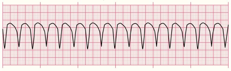 "Rekaman irama EKG menunjukkan Ventrikel Takikardia Monomorfik dengan kompleks QRS yang lebar dan reguler, salah satu irama EKG gawat darurat yang memerlukan penanganan segera.