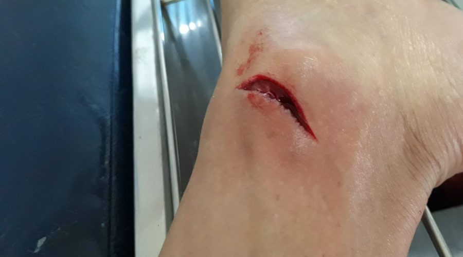 Acute wound