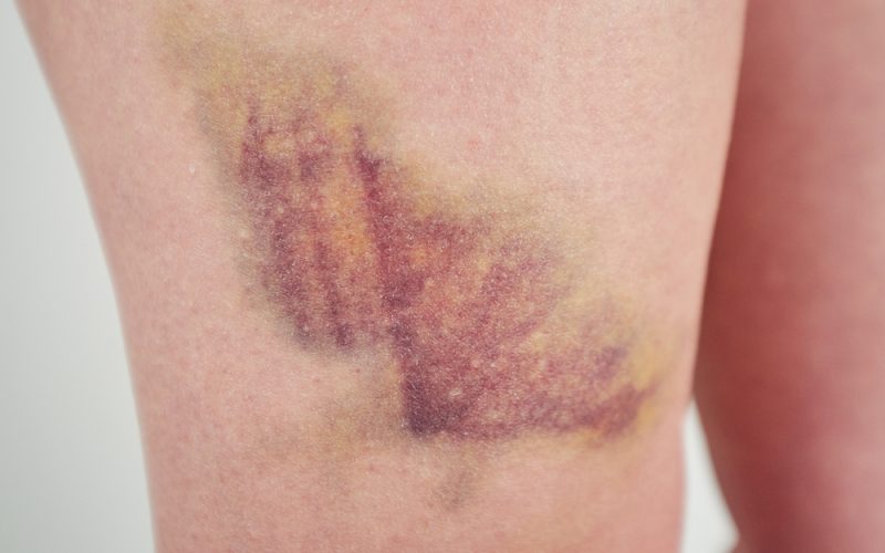 Example of a closed wound