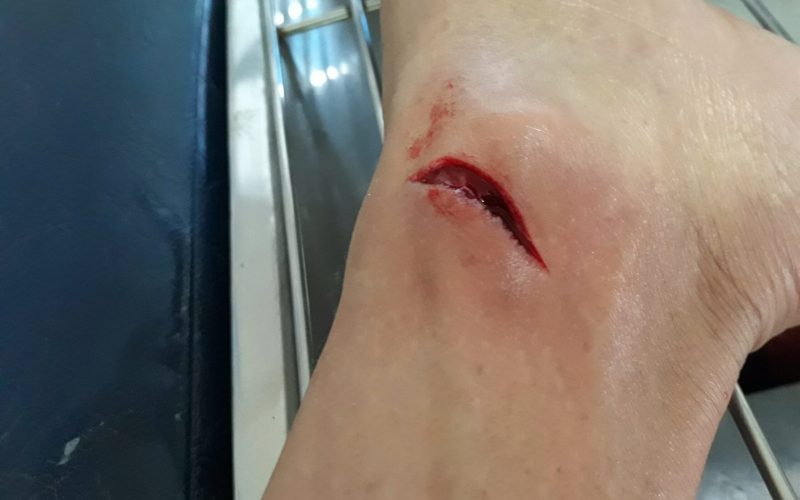Contoh luka tertutup