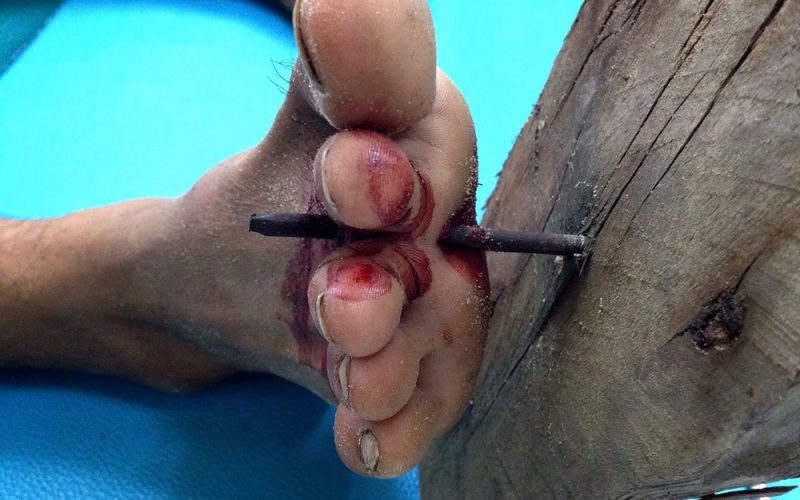 An example of an open wound