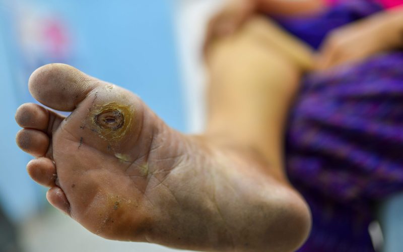 Seorang pria dengan ulkus kaki diabetik yang menunjukkan kerusakan jaringan